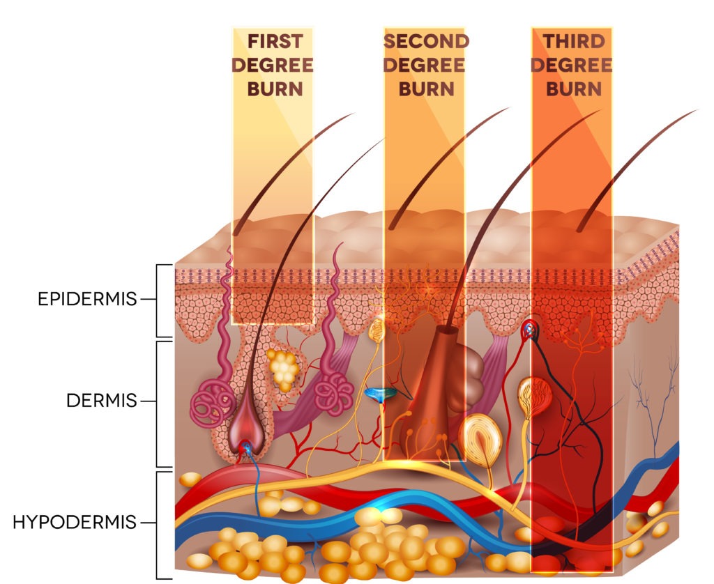 What Are the Common Causes of Degree Burns?