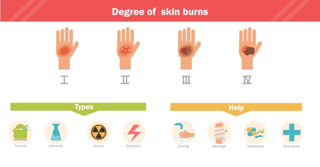How Are Burn Injuries Categorized?
