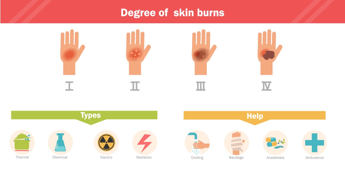 Three Points Chemical Burns At Work thumbnail