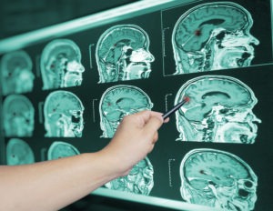 A Doctor Pointing To A–Brain Scan Showing A Traumatic Brain Injury