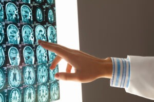 a-doctor-pointing-at-the-brain-scan-of-a-suspected-traumatic-brain-injury-victim