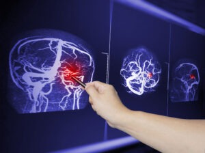 Un abogado de lesiones cerebrales traumáticas le puede ayudar a cobrar compensación